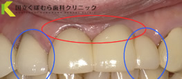 歯の根元が黒い・左右非対称の治療治療後