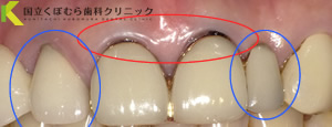 歯の根元が黒い・左右非対称の治療治療前