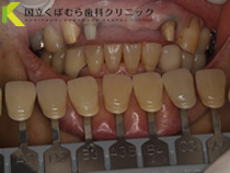歯の色調検査