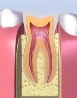 虫歯の進行C0